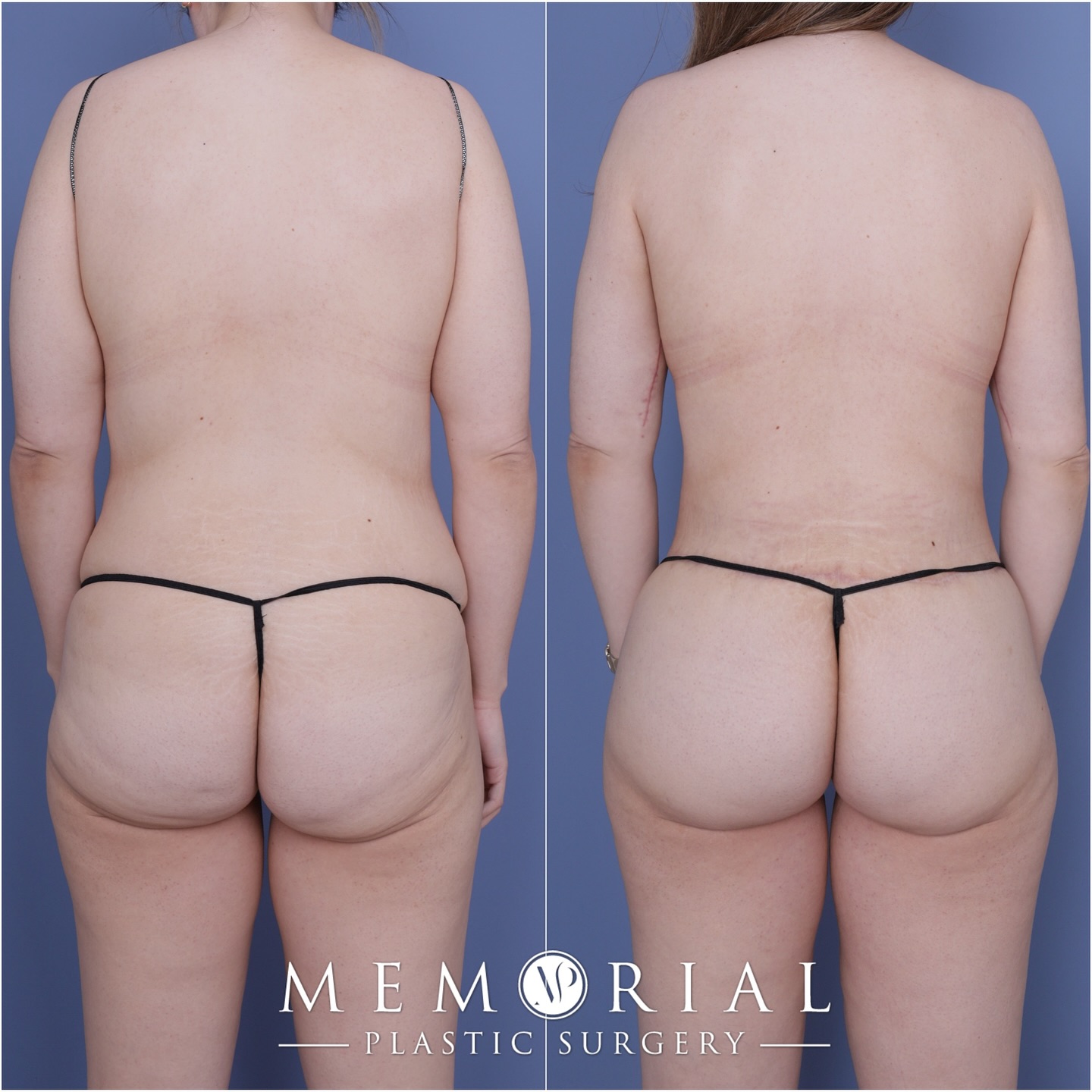 6 month post-op result after she lost 100 lbs through diet & exercise 🙌🏼 Final step on her weight loss journey was to get the excess skin removed and she’s looking amazing! So happy for her ☺️
Procedure: Circumferential Body Lift, Mastopexy + Lipo360 🤩
(Pre-Sx Wt: 161 lbs Ht: 5’8 BMI: 24.5)
#bodylift #newbody #plasticsurgeon #weightlossstory #transformation #tummytuck #bodytransformation #breastsurgery #houstonplasticsurgeon #drvasilakis @memorialplasticsurgery